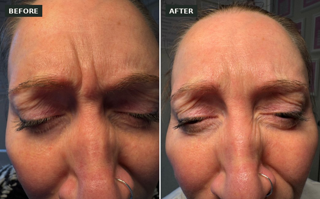Anti-wrinkle frown lines before and after at The Elegance Clinic, Welwyn Garden City