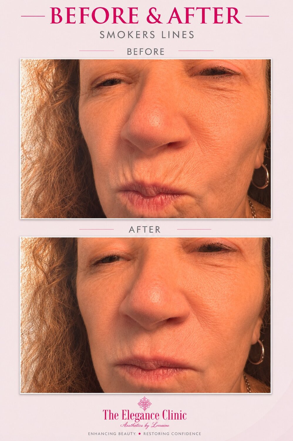Smokers lines anti-wrinkle before and after at The Elegance Clinic, Welwyn Garden City