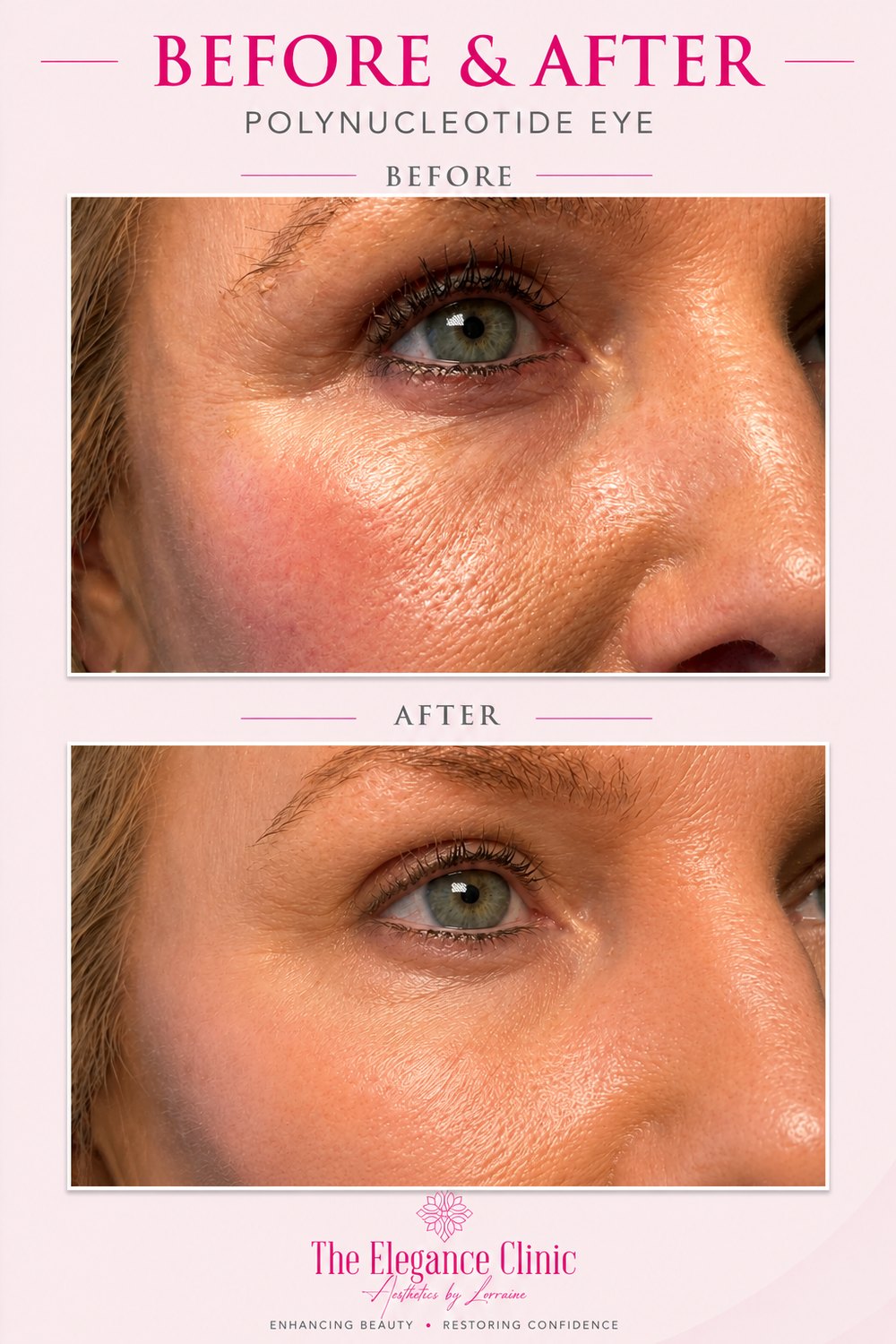 Polynucleotide under-eye before and after at The Elegance Clinic, Welwyn Garden City