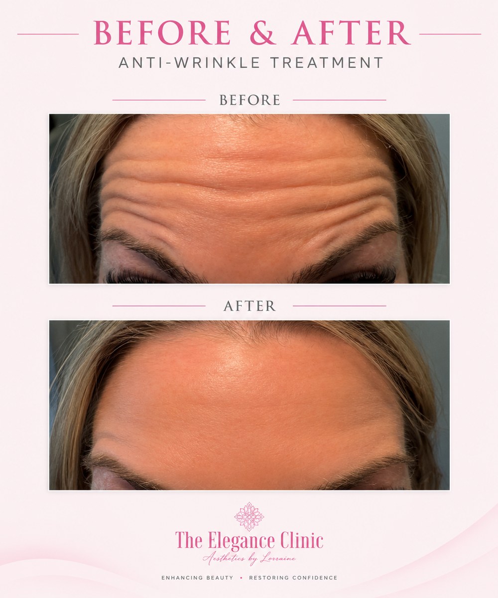 Anti-wrinkle before and after at The Elegance Clinic, Welwyn Garden City