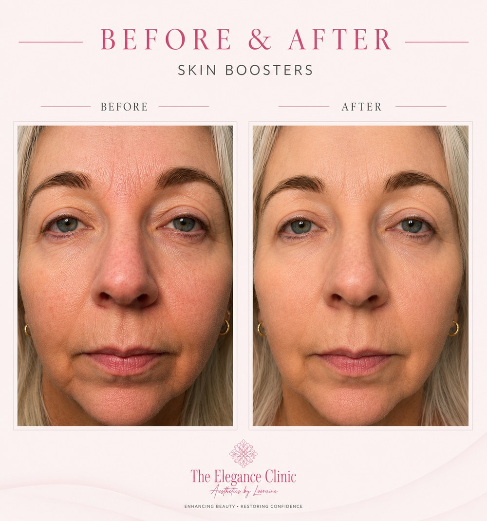 Skin booster before and after at The Elegance Clinic, Welwyn Garden City