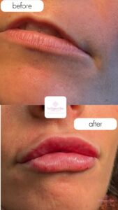 fillerBeforeAfterClient1